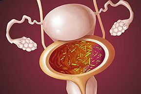 Bakterinis cistitas moteriai